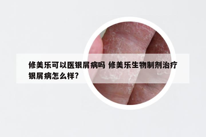 修美乐可以医银屑病吗 修美乐生物制剂治疗银屑病怎么样?