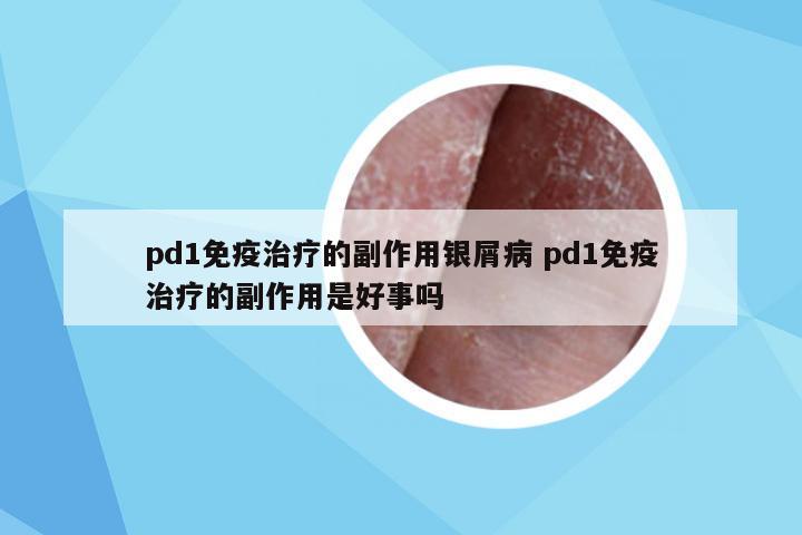 pd1免疫治疗的副作用银屑病 pd1免疫治疗的副作用是好事吗