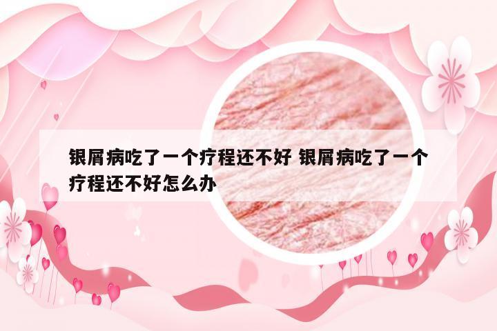 银屑病吃了一个疗程还不好 银屑病吃了一个疗程还不好怎么办