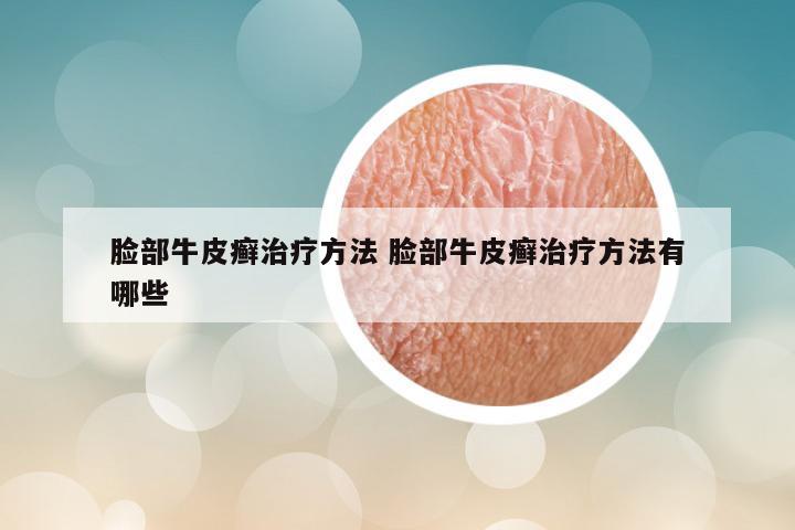 脸部牛皮癣治疗方法 脸部牛皮癣治疗方法有哪些