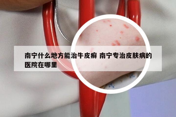 南宁什么地方能治牛皮癣 南宁专治皮肤病的医院在哪里