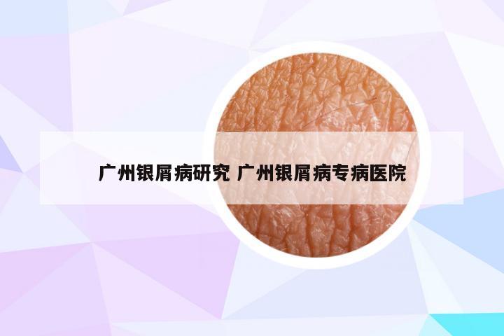 广州银屑病研究 广州银屑病专病医院