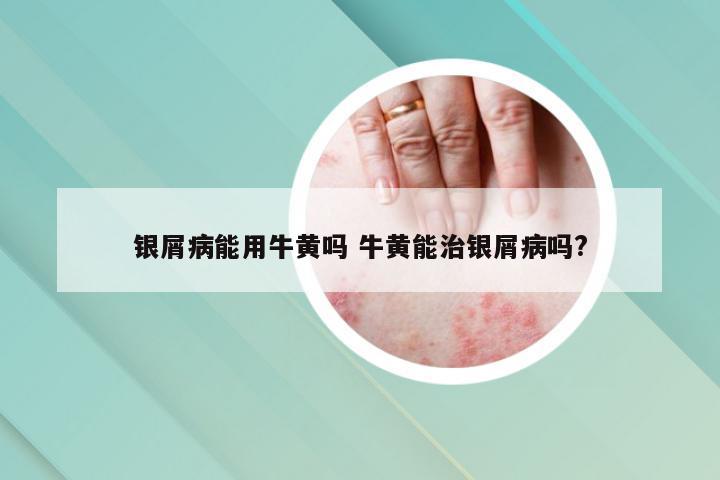 银屑病能用牛黄吗 牛黄能治银屑病吗?
