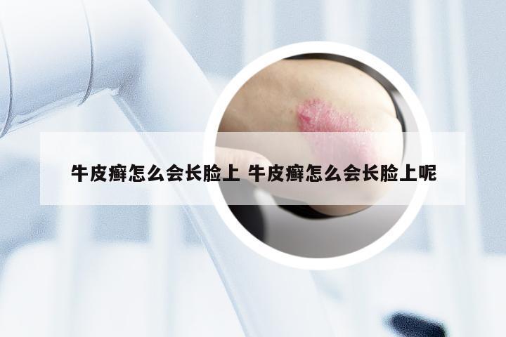 牛皮癣怎么会长脸上 牛皮癣怎么会长脸上呢