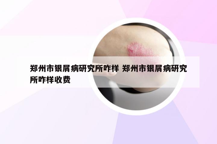 郑州市银屑病研究所咋样 郑州市银屑病研究所咋样收费