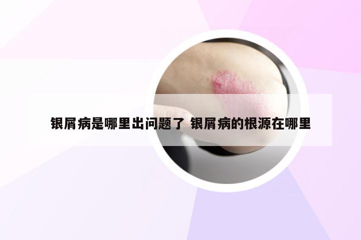 银屑病是哪里出问题了 银屑病的根源在哪里