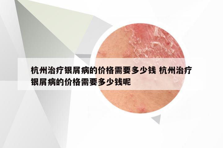 杭州治疗银屑病的价格需要多少钱 杭州治疗银屑病的价格需要多少钱呢