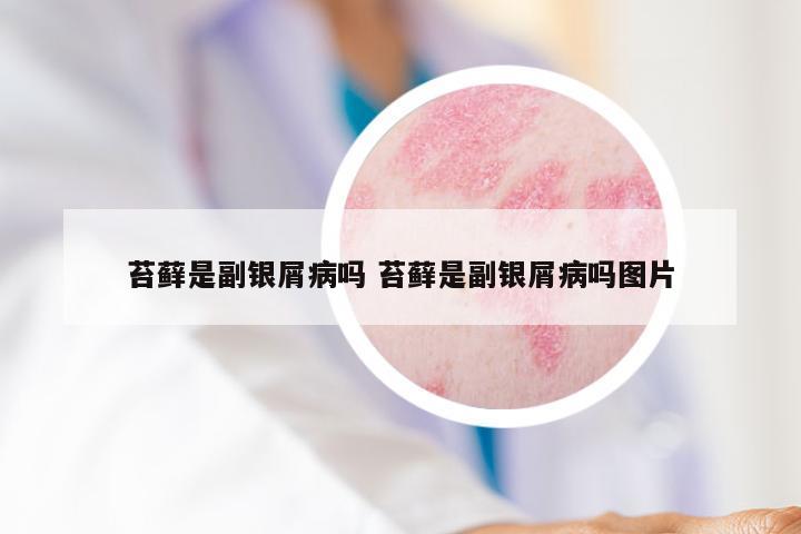 苔藓是副银屑病吗 苔藓是副银屑病吗图片
