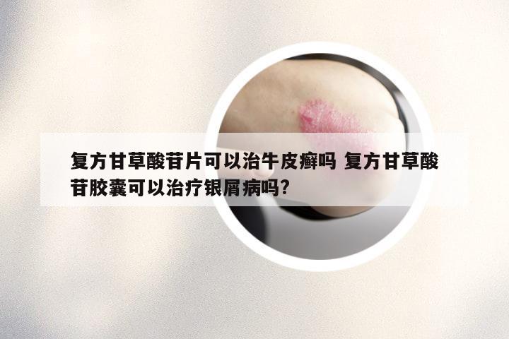 复方甘草酸苷片可以治牛皮癣吗 复方甘草酸苷胶囊可以治疗银屑病吗?