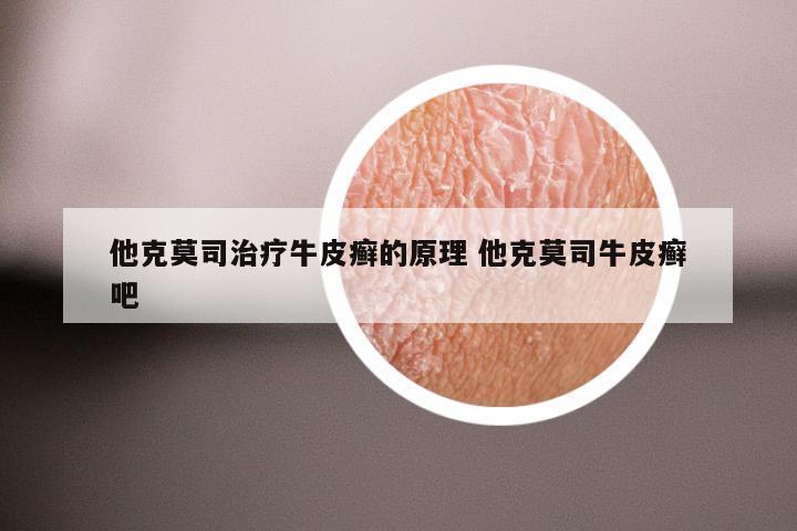 他克莫司治疗牛皮癣的原理 他克莫司牛皮癣吧