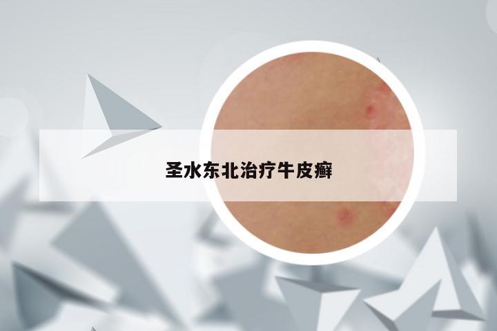 圣水东北治疗牛皮癣