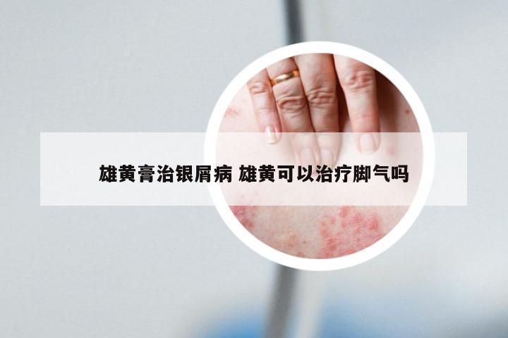 雄黄膏治银屑病 雄黄可以治疗脚气吗