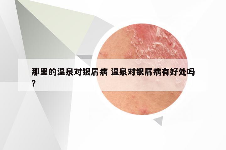 那里的温泉对银屑病 温泉对银屑病有好处吗?