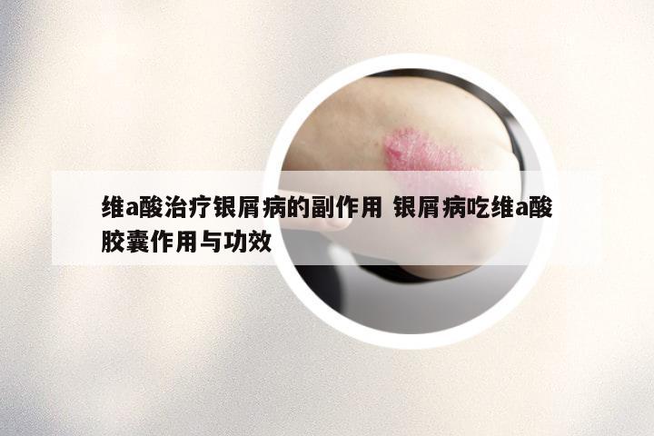 维a酸治疗银屑病的副作用 银屑病吃维a酸胶囊作用与功效