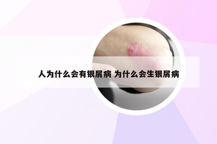 人为什么会有银屑病 为什么会生银屑病
