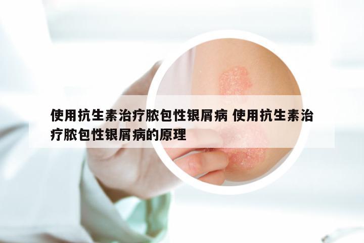 使用抗生素治疗脓包性银屑病 使用抗生素治疗脓包性银屑病的原理