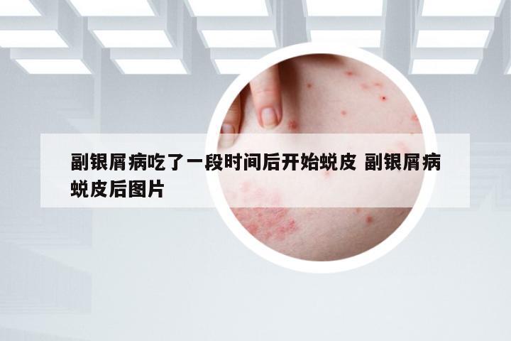 副银屑病吃了一段时间后开始蜕皮 副银屑病蜕皮后图片