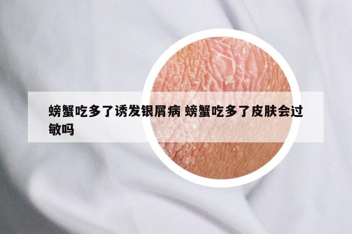 螃蟹吃多了诱发银屑病 螃蟹吃多了皮肤会过敏吗