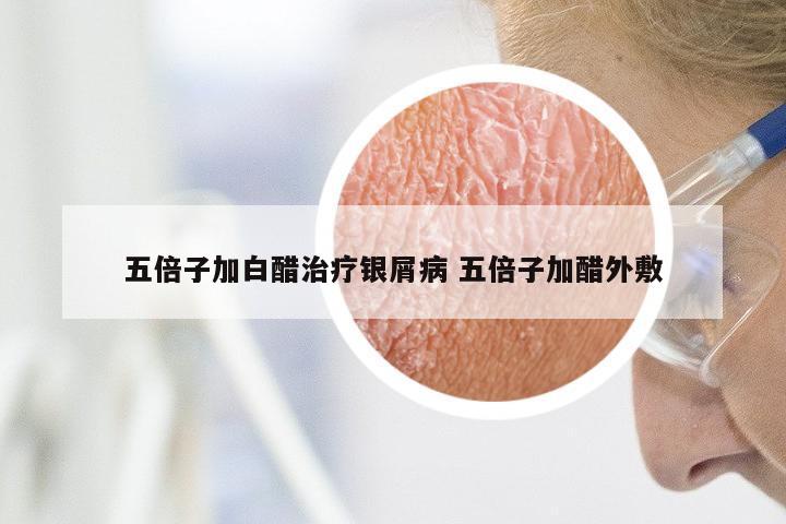 五倍子加白醋治疗银屑病 五倍子加醋外敷