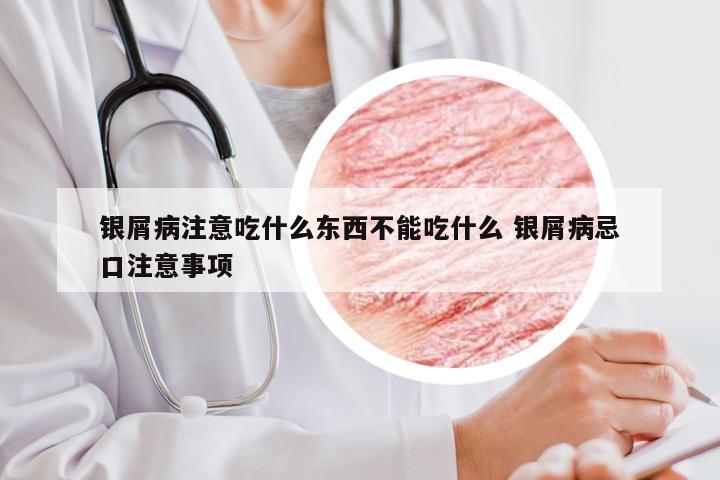 银屑病注意吃什么东西不能吃什么 银屑病忌口注意事项