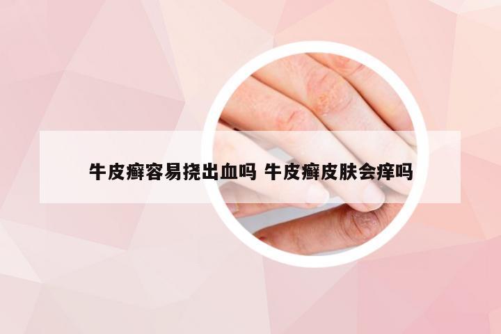 牛皮癣容易挠出血吗 牛皮癣皮肤会痒吗