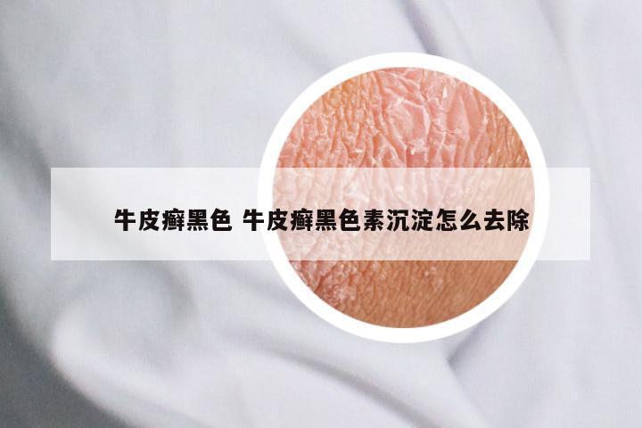 牛皮癣黑色 牛皮癣黑色素沉淀怎么去除