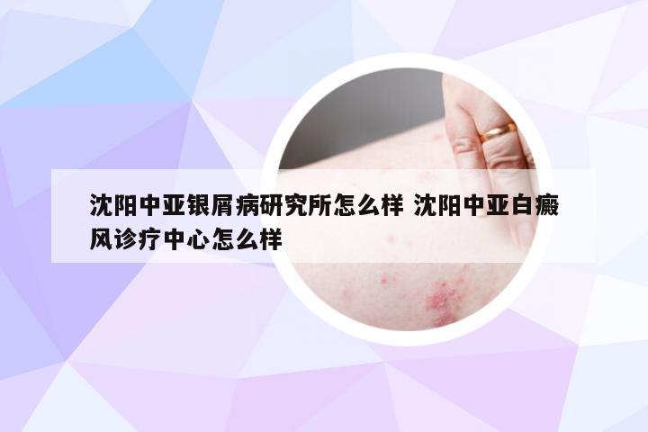 沈阳中亚银屑病研究所怎么样 沈阳中亚白癜风诊疗中心怎么样