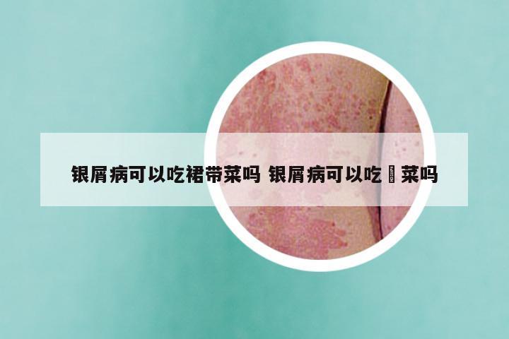 银屑病可以吃裙带菜吗 银屑病可以吃韮菜吗