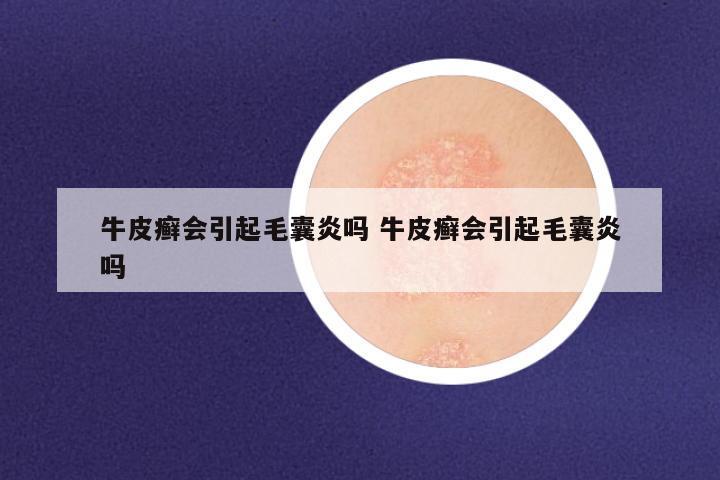 牛皮癣会引起毛囊炎吗 牛皮癣会引起毛囊炎吗