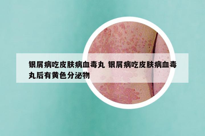 银屑病吃皮肤病血毒丸 银屑病吃皮肤病血毒丸后有黄色分泌物