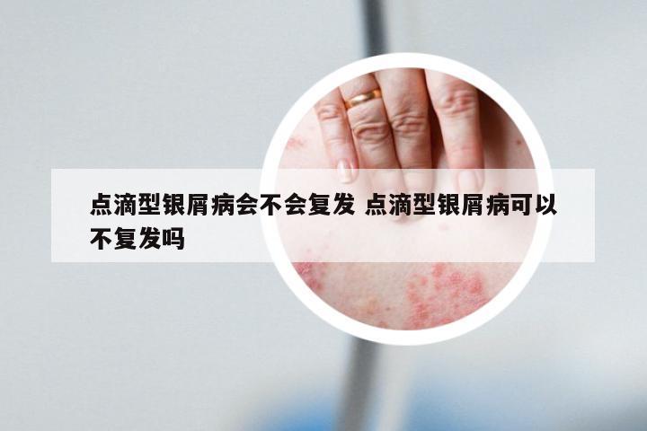 点滴型银屑病会不会复发 点滴型银屑病可以不复发吗