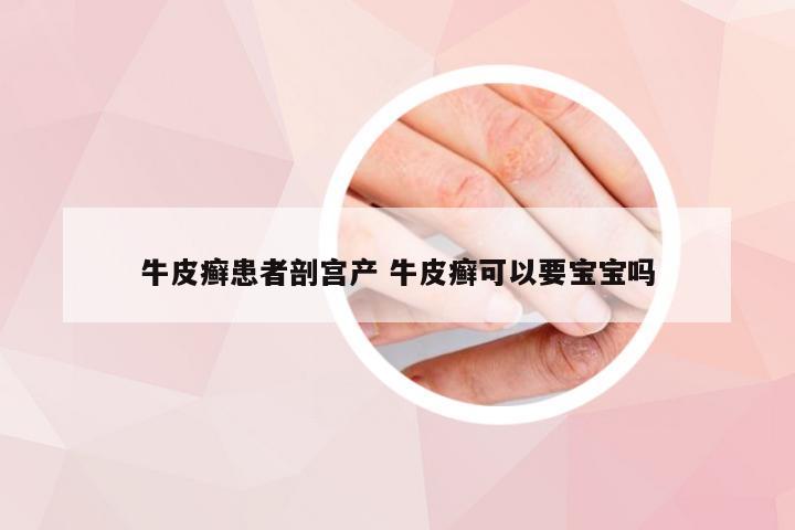 牛皮癣患者剖宫产 牛皮癣可以要宝宝吗