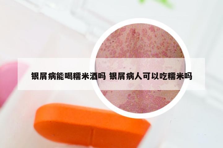 银屑病能喝糯米酒吗 银屑病人可以吃糯米吗