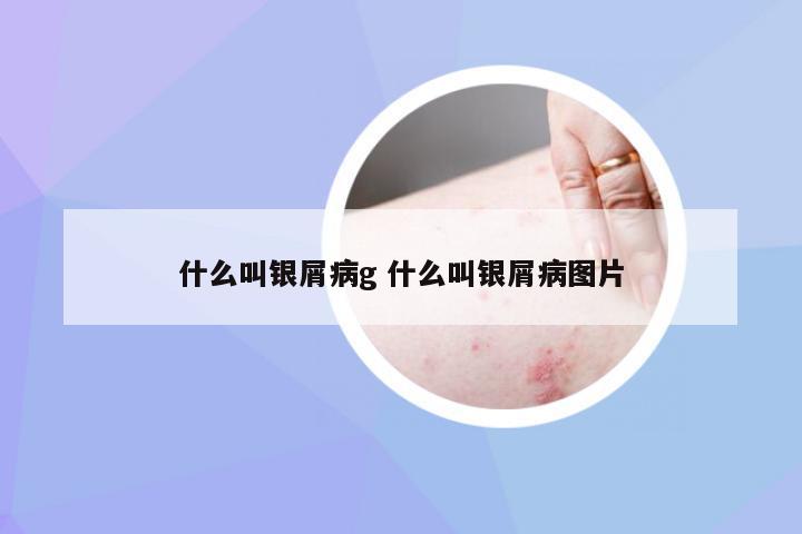 什么叫银屑病g 什么叫银屑病图片