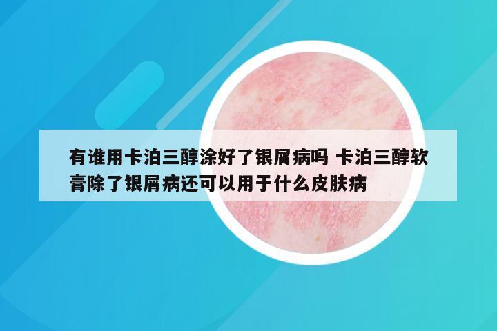 有谁用卡泊三醇涂好了银屑病吗 卡泊三醇软膏除了银屑病还可以用于什么皮肤病