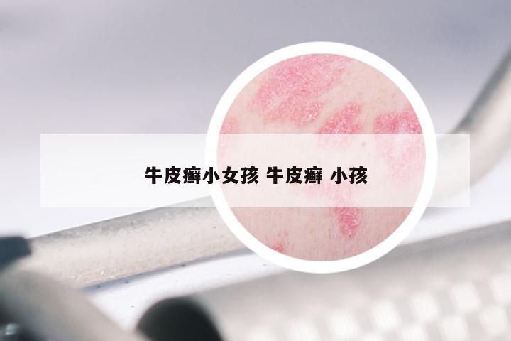 牛皮癣小女孩 牛皮癣 小孩