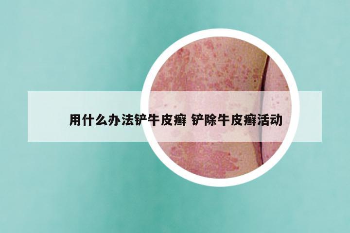 用什么办法铲牛皮癣 铲除牛皮癣活动