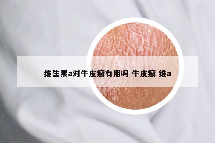 维生素a对牛皮癣有用吗 牛皮癣 维a