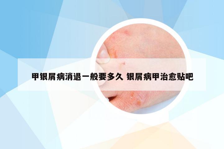 甲银屑病消退一般要多久 银屑病甲治愈贴吧