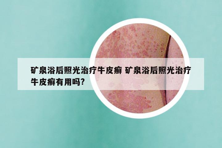 矿泉浴后照光治疗牛皮癣 矿泉浴后照光治疗牛皮癣有用吗?