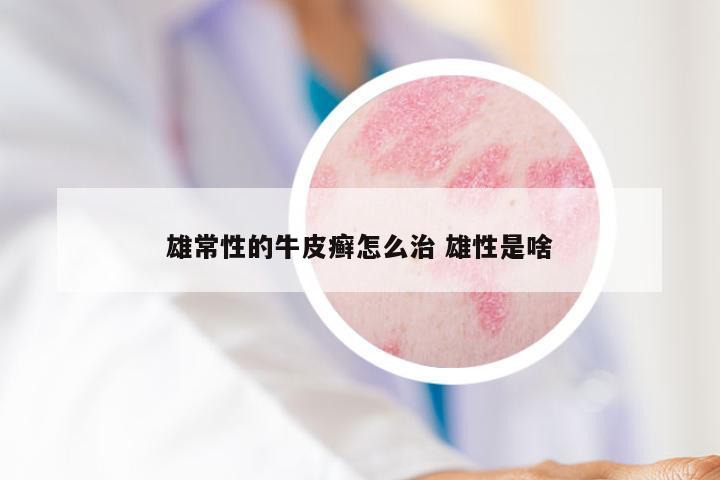 雄常性的牛皮癣怎么治 雄性是啥