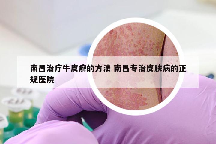 南昌治疗牛皮癣的方法 南昌专治皮肤病的正规医院