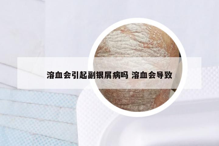 溶血会引起副银屑病吗 溶血会导致