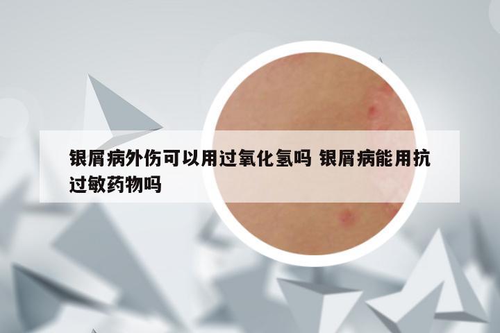 银屑病外伤可以用过氧化氢吗 银屑病能用抗过敏药物吗