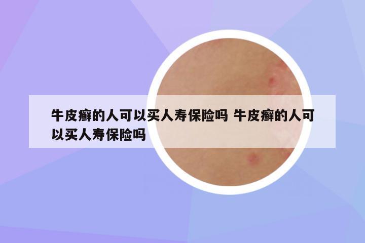 牛皮癣的人可以买人寿保险吗 牛皮癣的人可以买人寿保险吗