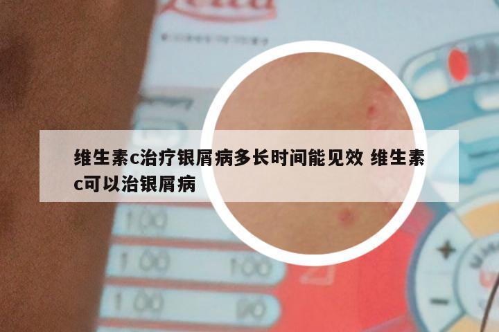 维生素c治疗银屑病多长时间能见效 维生素c可以治银屑病