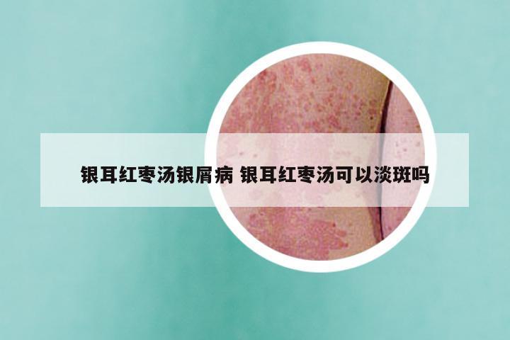 银耳红枣汤银屑病 银耳红枣汤可以淡斑吗