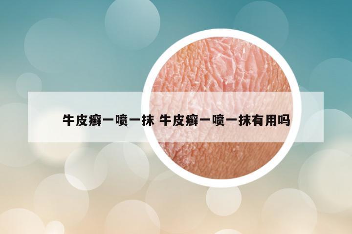 牛皮癣一喷一抹 牛皮癣一喷一抹有用吗