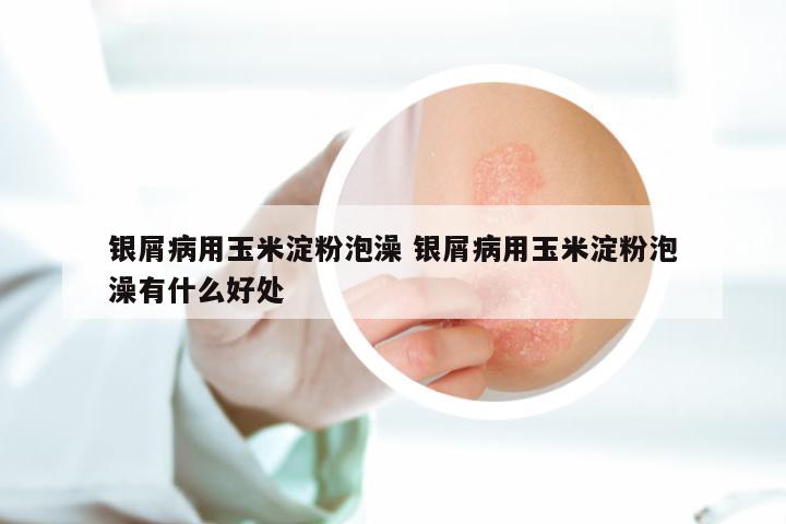 银屑病用玉米淀粉泡澡 银屑病用玉米淀粉泡澡有什么好处