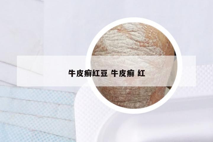 牛皮癣红豆 牛皮癣 红
